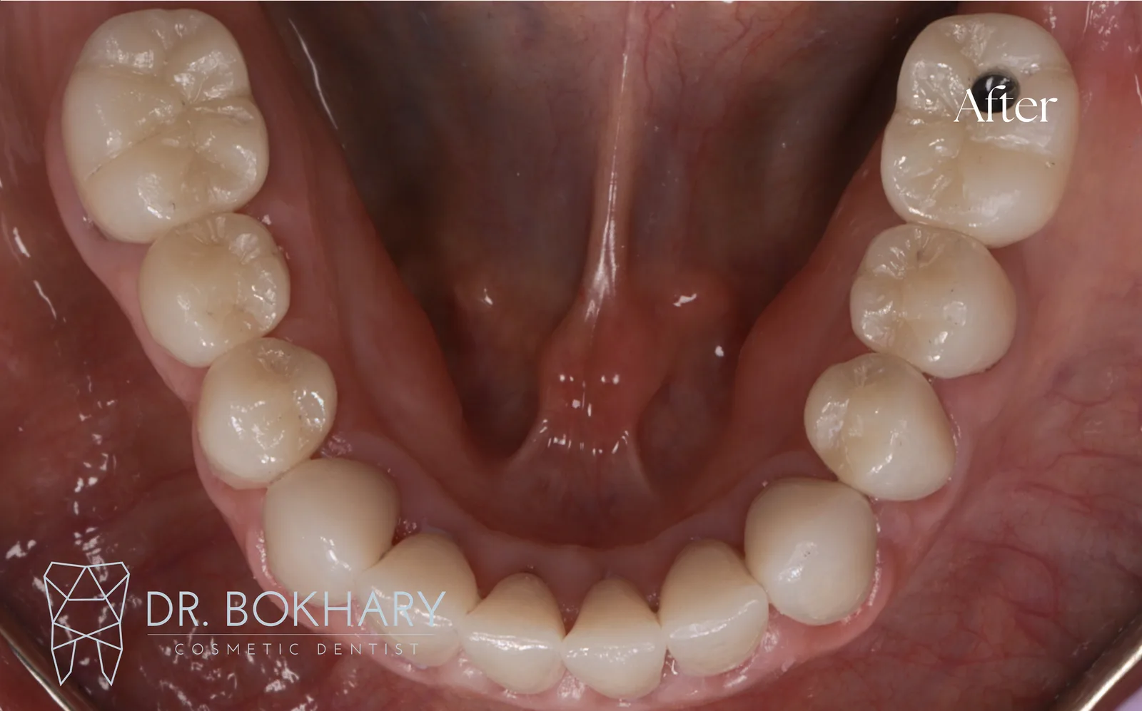صورة ما بعد العلاج — case-004